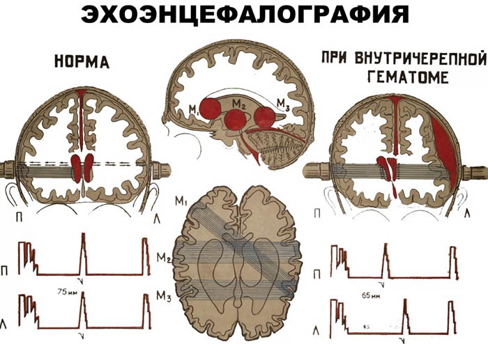 Эхоэнцефалография (ЭХО-ЭГ). Что это такое у детей, как делается