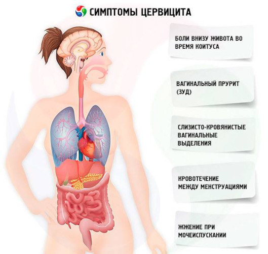 Экзоцервикс (экзоцервицит). Что это такое в гинекологии, расшифровка, лечение