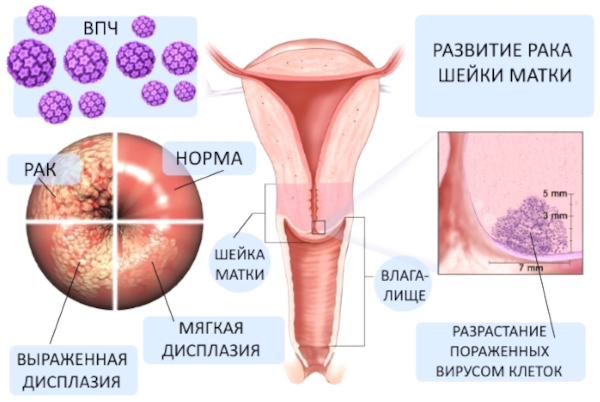 Экзоцервикс (экзоцервицит). Что это такое в гинекологии, расшифровка, лечение