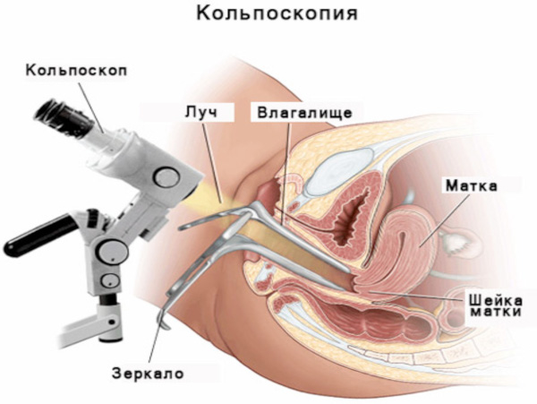 Экзоцервикс (экзоцервицит). Что это такое в гинекологии, расшифровка, лечение