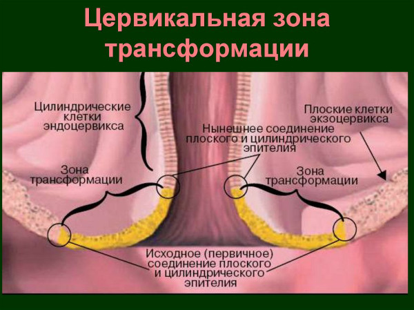 Экзоцервикс (экзоцервицит). Что это такое в гинекологии, расшифровка, лечение