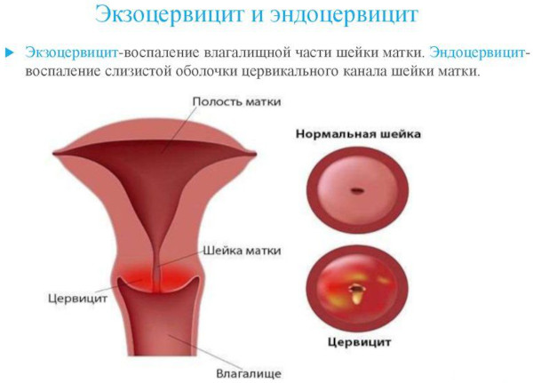 Экзоцервикс (экзоцервицит). Что это такое в гинекологии, расшифровка, лечение