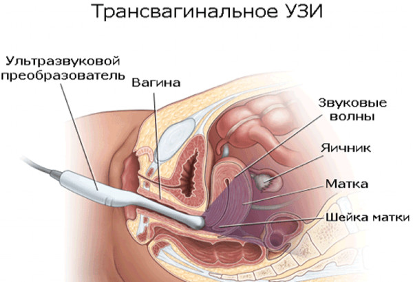 Гипоплазия эндометрия. Что это такое, лечение, причины возникновения