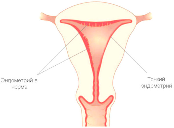 Гипоплазия эндометрия. Что это такое, лечение, причины возникновения