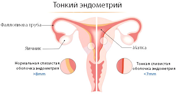 Гипоплазия эндометрия. Что это такое, лечение, причины возникновения