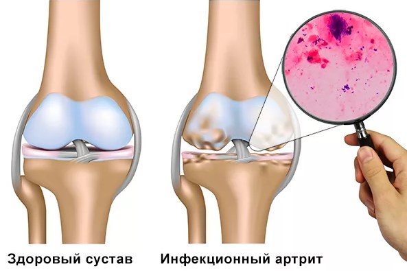 Инфекционный артрит. Симптомы и лечение антибиотиками