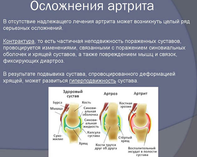 Реактивный артрит. Что это такое, симптомы и лечение