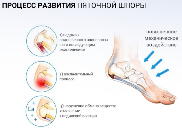 Лечение пяточной шпоры лазером. Цена, отзывы