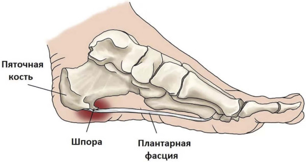 Лечение пяточной шпоры лазером. Цена, отзывы