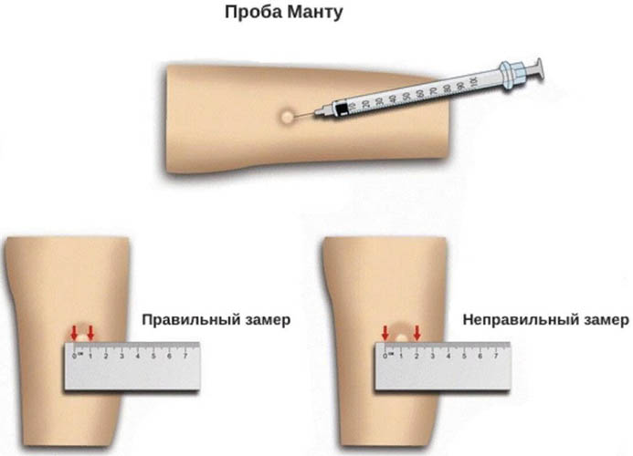 Манту и диаскинтест результаты фото