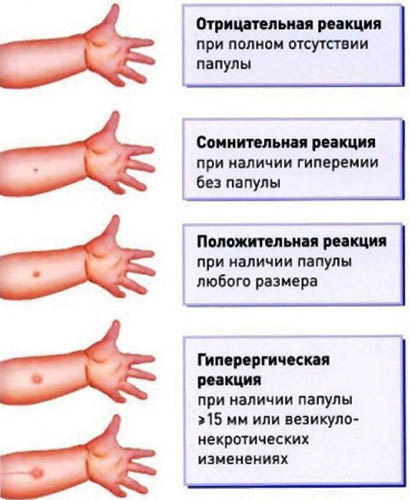 Манту и диаскинтест результаты фото