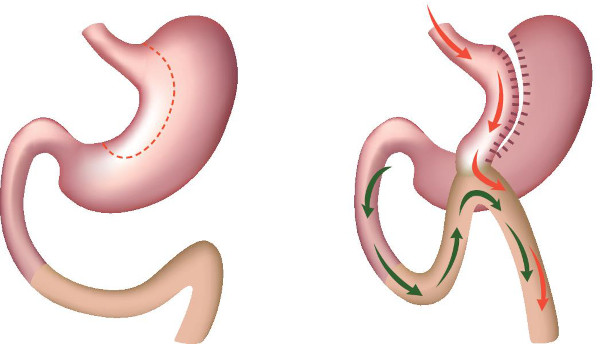 Мини-гастрошунтирование желудка. Что это, цена, отзывы