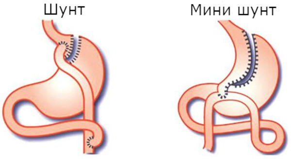 Мини-гастрошунтирование желудка. Что это, цена, отзывы