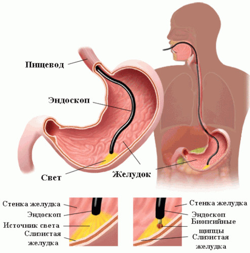 Мини-гастрошунтирование желудка. Что это, цена, отзывы