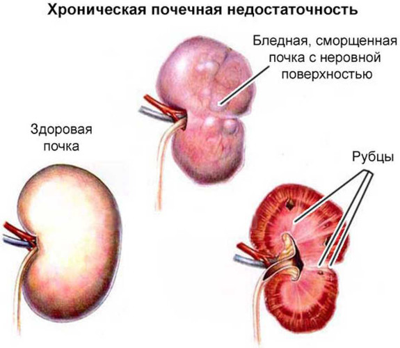 Мирабегрон. Инструкция по применению, цена, отзывы