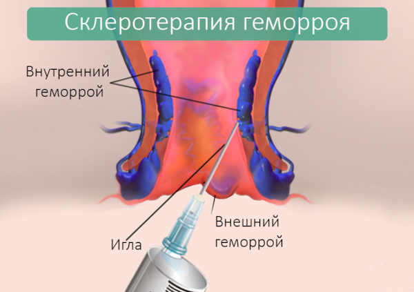 Операция на геморрой. Сколько стоит удаление лазером, отзывы