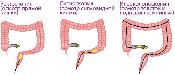 Операция на геморрой. Сколько стоит удаление лазером, отзывы