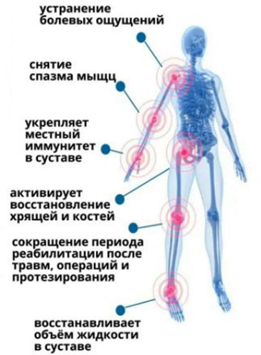 Плазмолифтинг для суставов. Что это такое, отзывы, цена