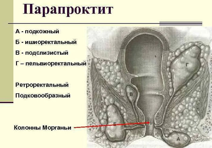 Подкожный парапроктит. Что это, лечение антибиотиками