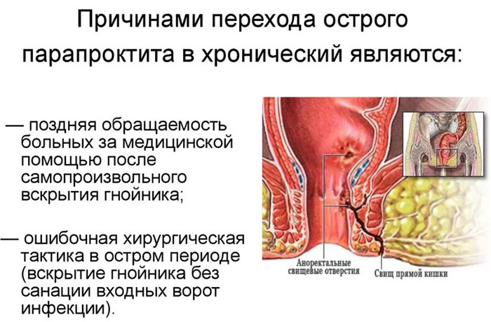 Подкожный парапроктит. Что это, лечение антибиотиками