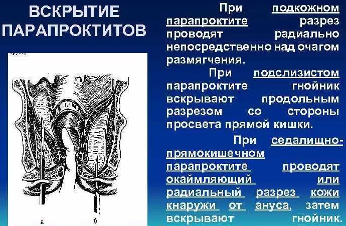 Подкожный парапроктит. Что это, лечение антибиотиками