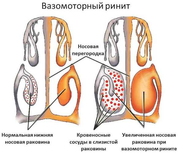 Прижигание сосудов слизистой в носу лазером. Цена