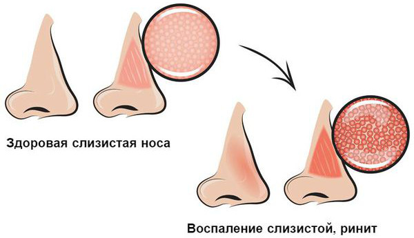 Прижигание сосудов слизистой в носу лазером. Цена