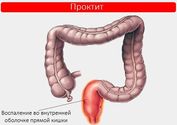 Проктит. Симптомы и лечение воспаления прямой кишки