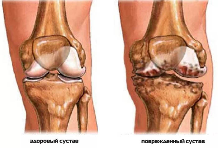 Спазмалгон и аналоги дешевле по составу. Список