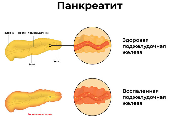 Реактивный панкреатит. Что это такое, лечение, симптомы у взрослых