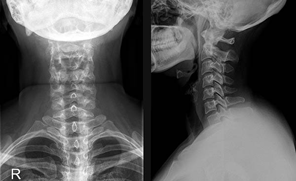 Рентгенография шейного отдела позвоночника с функциональными пробами