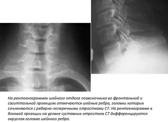 Рентгенография шейного отдела позвоночника с функциональными пробами