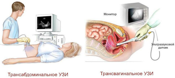 Скрининг УЗИ 1-2-3 триместра пренатальный. Что это, расшифровка