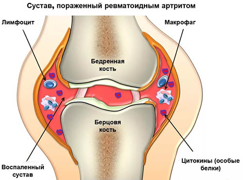 Уколы от ревматоидного артрита суставов внутримышечно. Названия