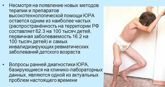 Ювенильный ревматоидный артрит у детей. Клинические рекомендации