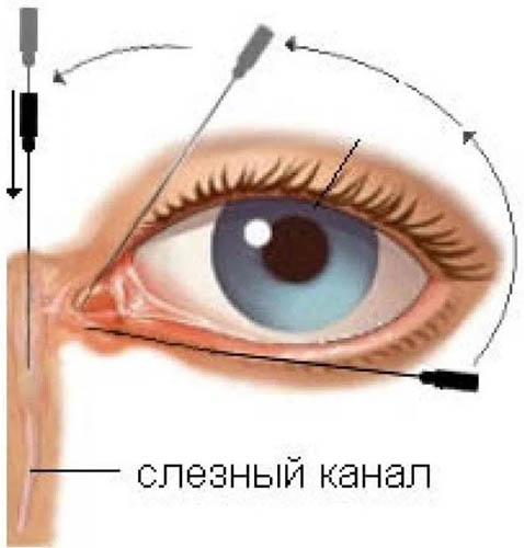 Зондирование слезного канала у новорожденных. Отзывы