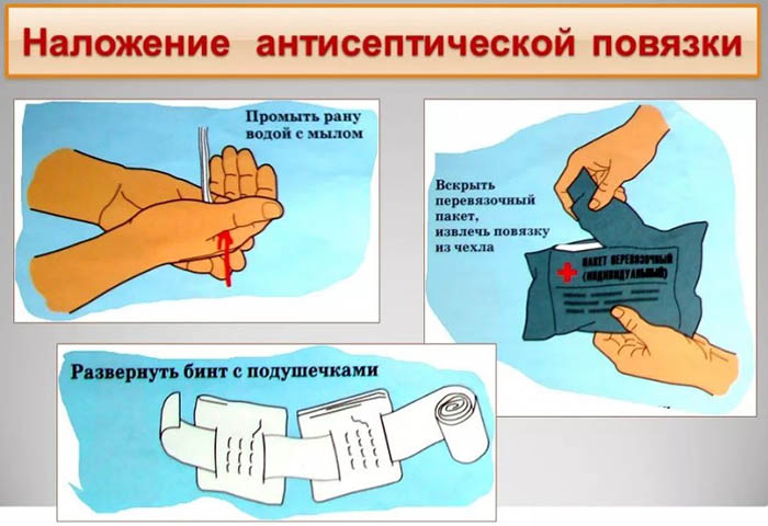 Асептическая повязка. Что это такое, алгоритм наложения на рану