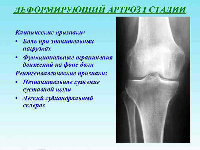 Деформирующий артроз (ДОА) коленного сустава 1-2 степени. Что это, лечение