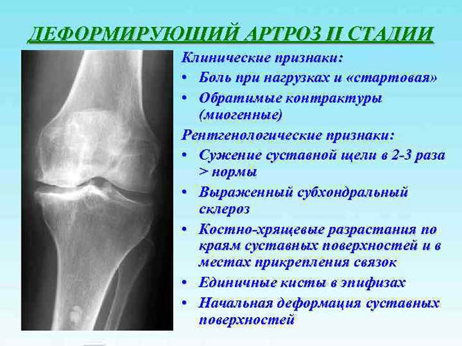 Деформирующий артроз (ДОА) коленного сустава 1-2 степени. Что это, лечение