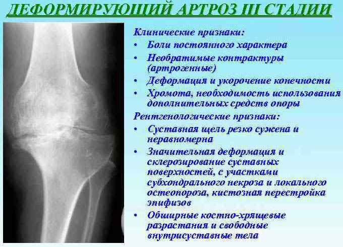 Деформирующий артроз (ДОА) коленного сустава 1-2 степени. Что это, лечение