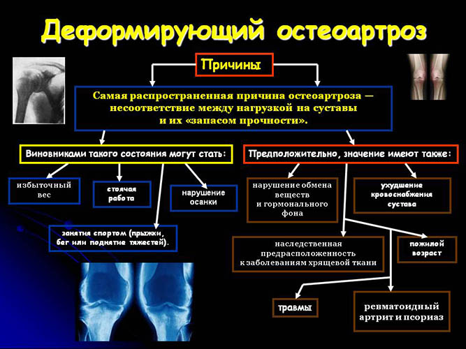 Деформирующий артроз (ДОА) коленного сустава 1-2 степени. Что это, лечение