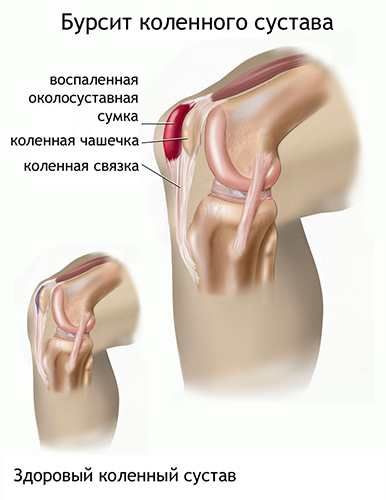 Деформирующий артроз (ДОА) коленного сустава 1-2 степени. Что это, лечение