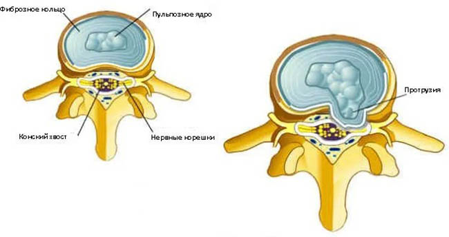 Дорзальная грыжа (экструзия) межпозвонкового диска. Что это такое
