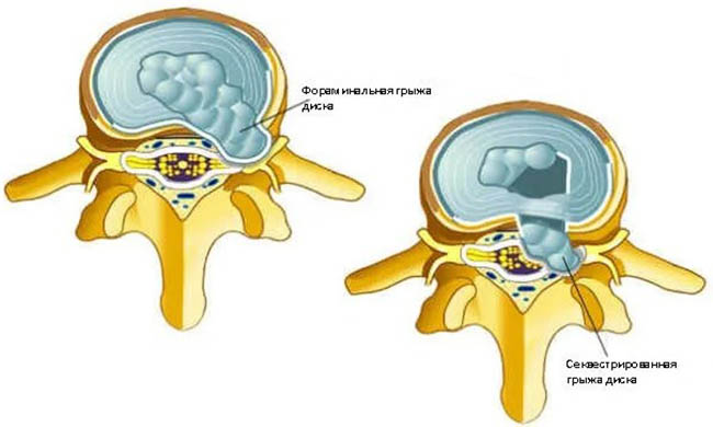 Дорзальная грыжа (экструзия) межпозвонкового диска. Что это такое