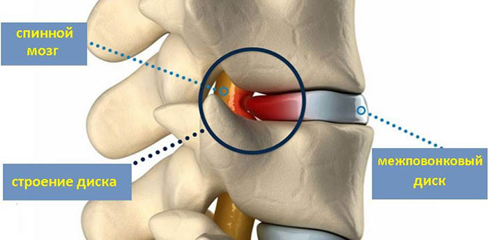 Дорзальная грыжа (экструзия) межпозвонкового диска. Что это такое