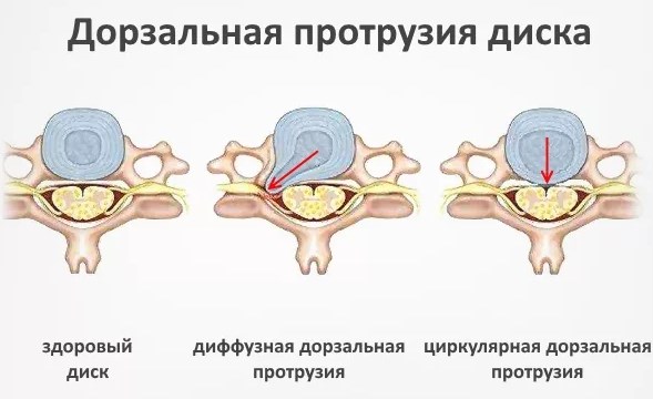 Дорзальная грыжа (экструзия) межпозвонкового диска. Что это такое