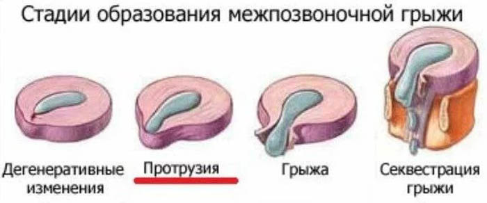 Дорзальная грыжа (экструзия) межпозвонкового диска. Что это такое