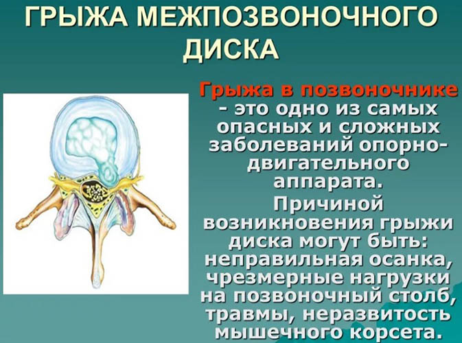 Дорзальная грыжа (экструзия) межпозвонкового диска. Что это такое