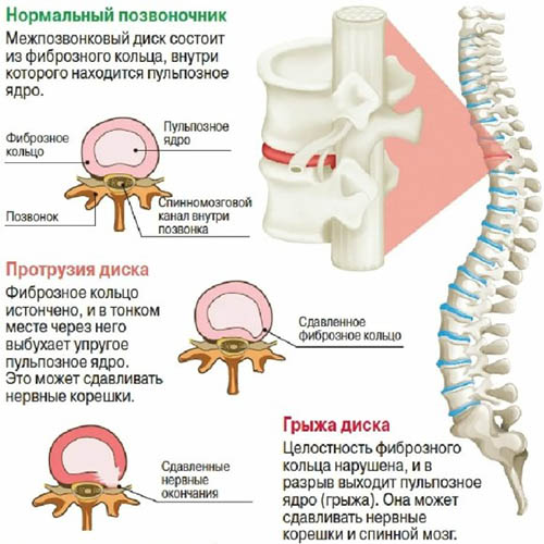 Дорзальная грыжа (экструзия) межпозвонкового диска. Что это такое