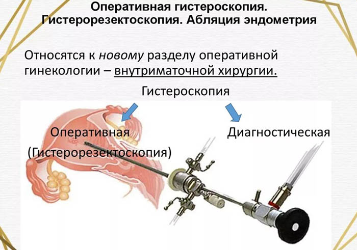 Гистерорезектоскопия полипа, миомы. Что это такое, цена, отзывы